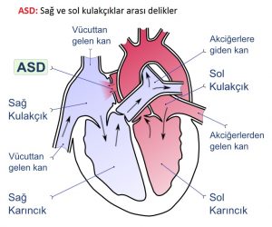 Kalp Delikliği ASD