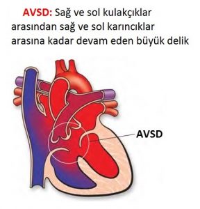 Kalp Delikliği AVSD
