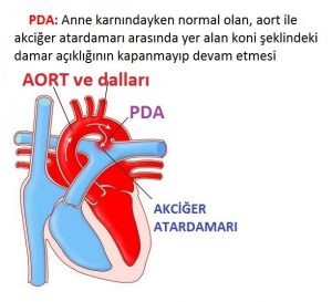 Kalp Delikliği PDA